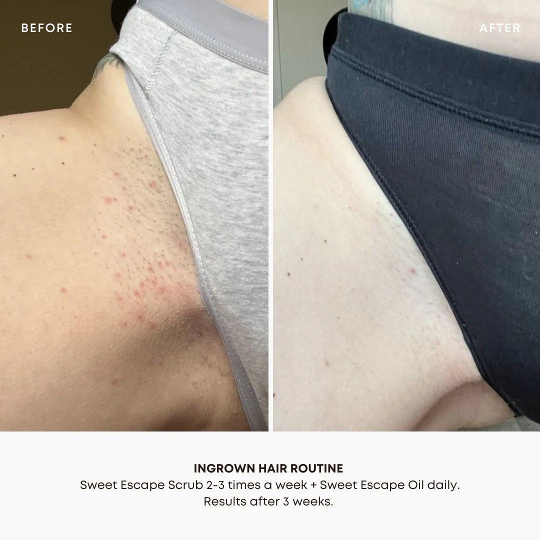 Sweet Escape Ingrown Treatment Oil (Travel Size)