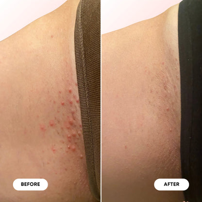 Summer Vacay Ingrown Treatment Oil