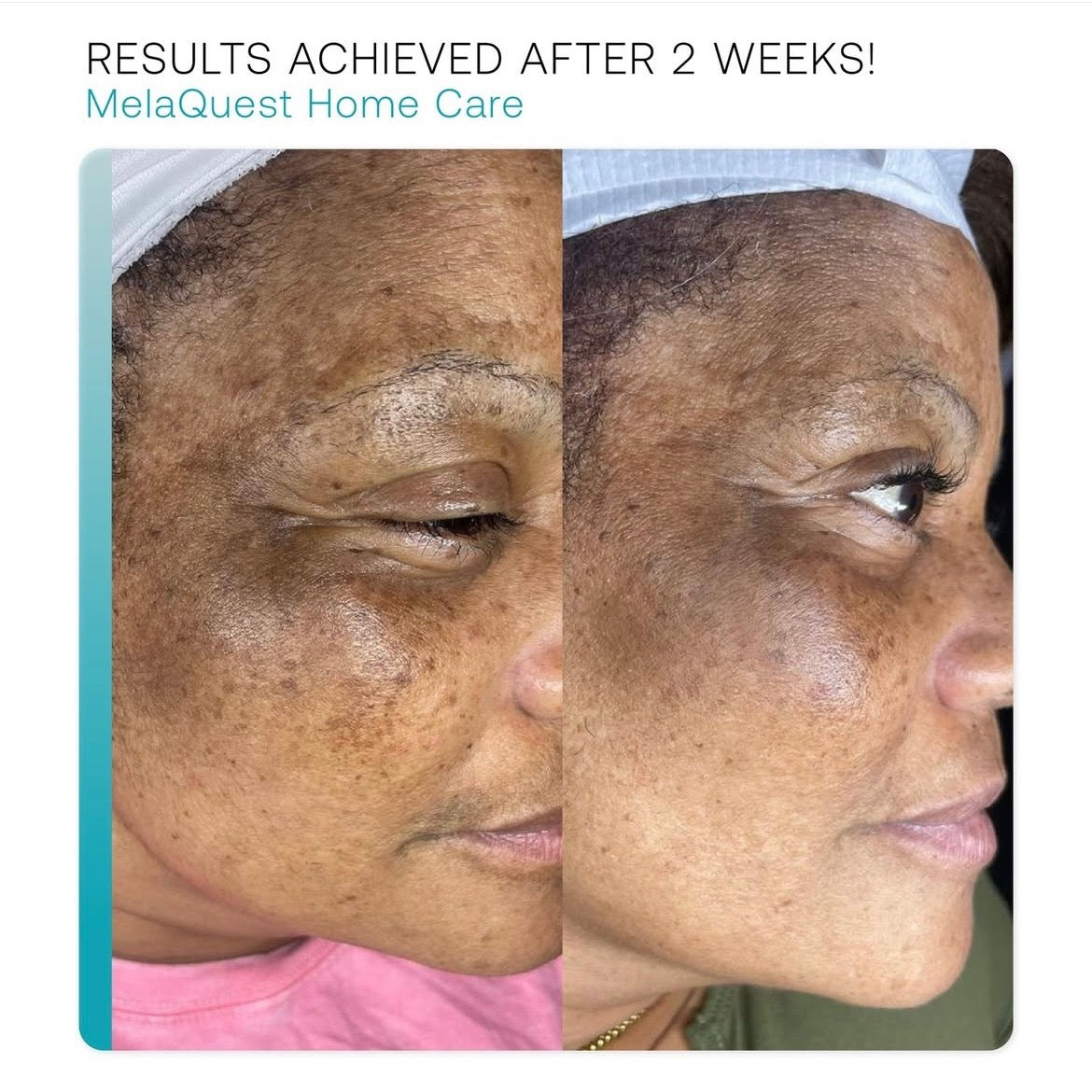 MelaQuest Cysteamine Serum
