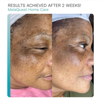 MelaQuest Cysteamine Serum