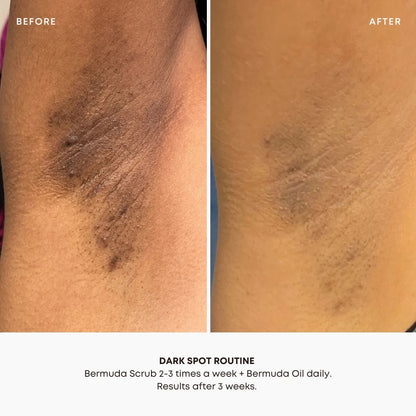 Bermuda Dark Spot + Ingrown Treatment Oil