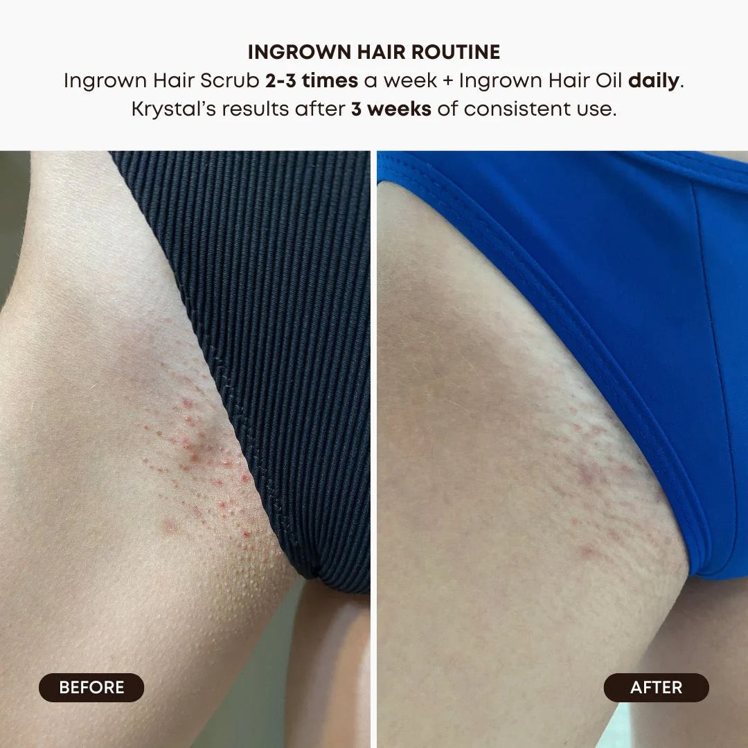 Watermelon Sugar Ingrown Treatment Oil