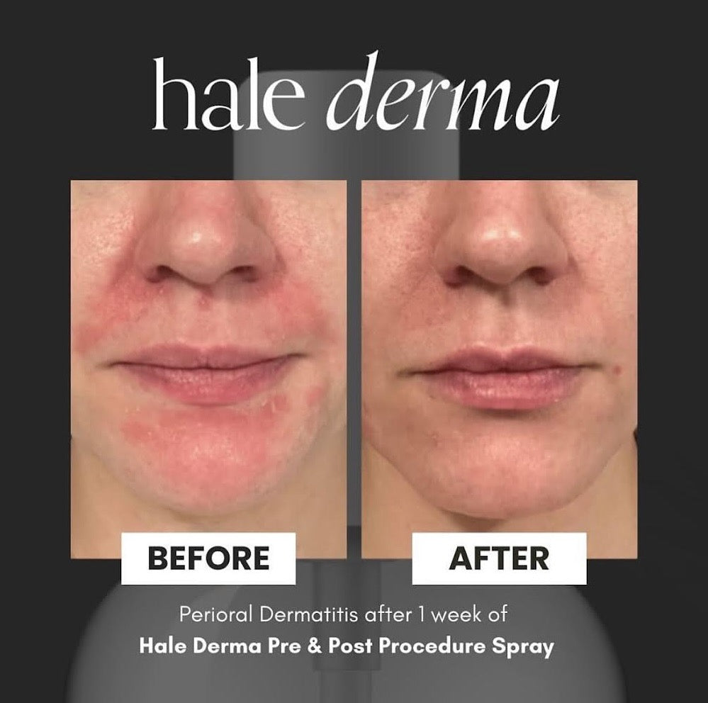 Hale Derma Hypochlorous Acid Spray