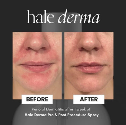 Hale Derma Hypochlorous Acid Spray
