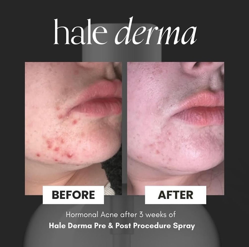 Hale Derma Hypochlorous Acid Spray