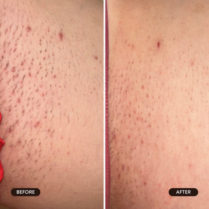 Berry Crush Ingrown Treatment Oil