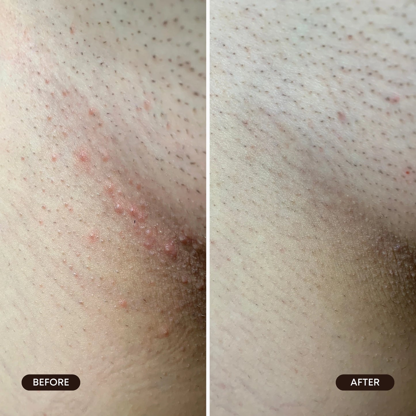 Berry Crush Ingrown Hair Exfoliating Scrub